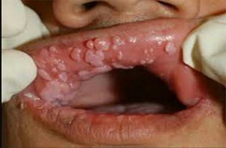 Ağız içi HPV Siğil