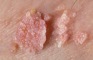 HPV Tipleri